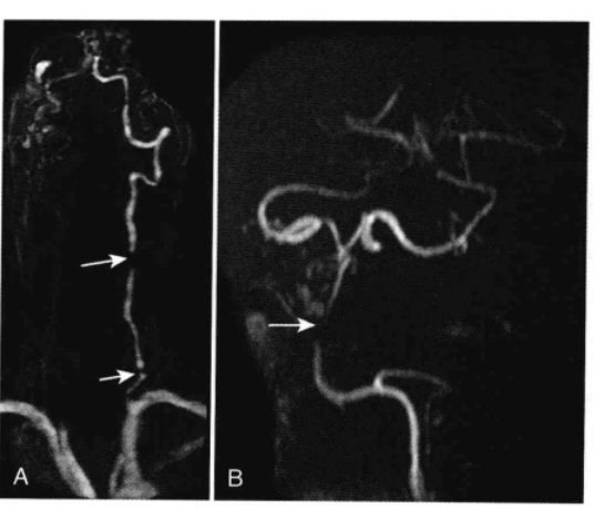 如何选择股票技巧 患者步态不稳，结合影像学检查，诊断考虑是？